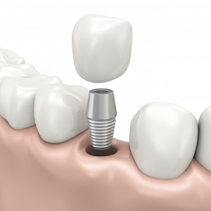 Dental-Implants Image