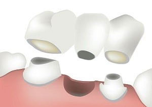 An example sketch of a dental bridge