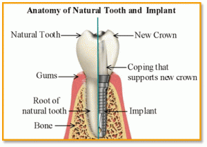 Anatomy Of A Dental Implant
