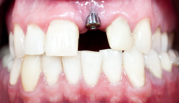 take care of dental implants