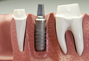 Taking care of dental implants
